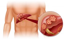 الكشف عن ميكانزم نشوء سرطان الكبد