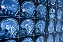 دراسة جديدة: وجود علاقة بين تكوين الدماغ والذكاء