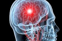 التدخل السريع ينقذ ضحايا السكتة الدماغية