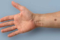 شامة اصطناعية انذار مبكر من السرطانات