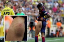 ألفيس كشف عن آثار إصابته فأشهر الحكم إنذاراً في وجهه!