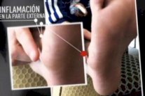 صورة تظهر إصابة نجم برشلونة ميسي بتورم في قدمه اليمنى