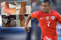 تورم شديد في كاحل سانشيز بعد نهائي كوبا أميركا