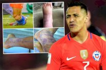 صور جديدة لقدم أليكسيس سانشيز تثير القلق في آرسنال