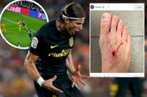 فيليبي لويس يكشف عن إصابته بعد تدخل سواريز