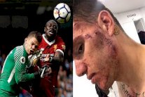 إيدرسون ينشر صورة وجهه المصاب بعد حادثة 