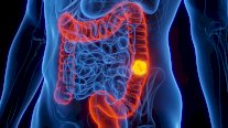 دراسة: أسباب صادمة لارتفاع معدلات إصابة الشباب بسرطان القولون