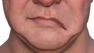 التهاب العصب السابع - Getty Images